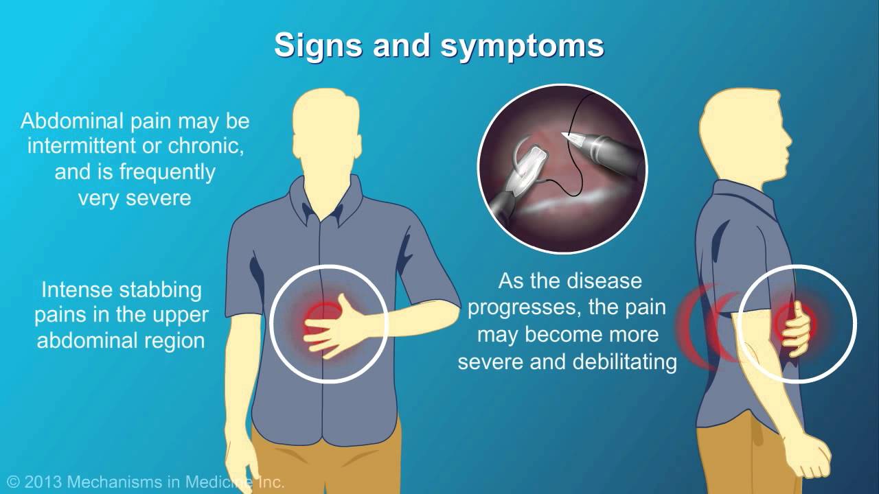 Chronic Pancreatitis