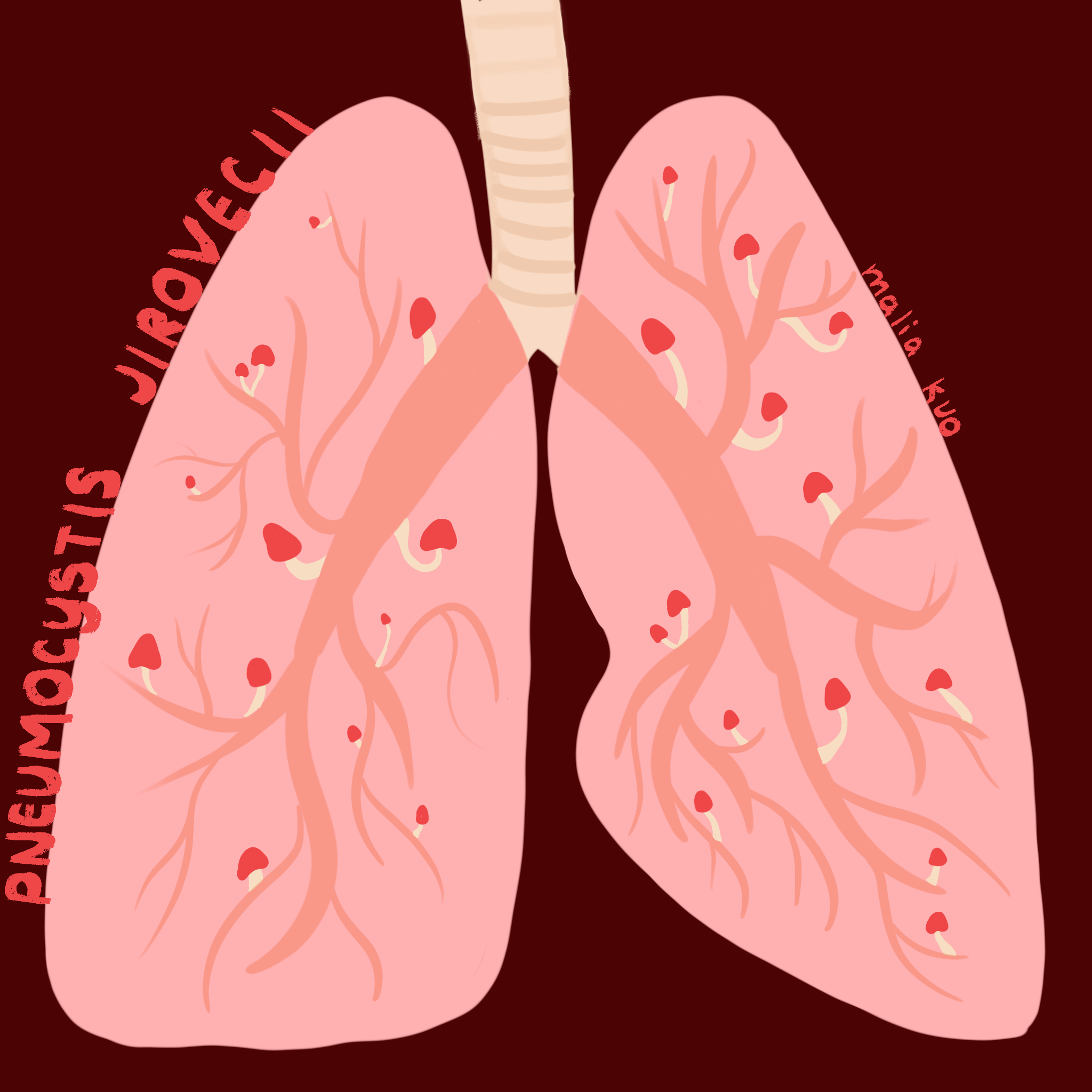 Pneumocystis Pneumonia Outbreak Chronicled In Clinical Infectious Diseases