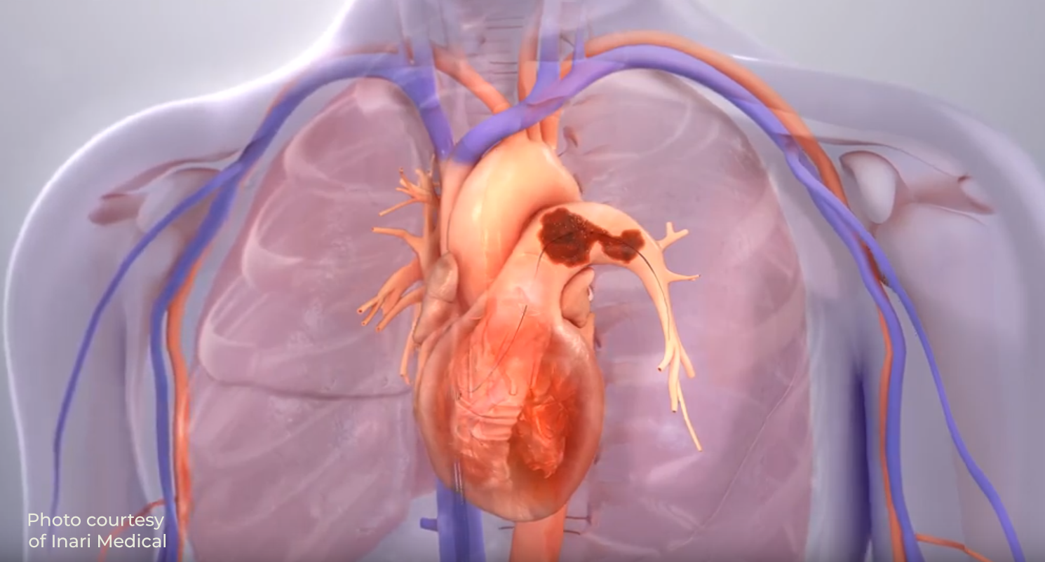 New Treatment to Remove Clots Offers Dramatic Results > Cardiovascular ...